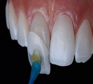 CARILLAS DENTALES